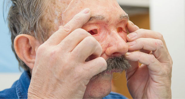 Prosthetics 3D-printed-face